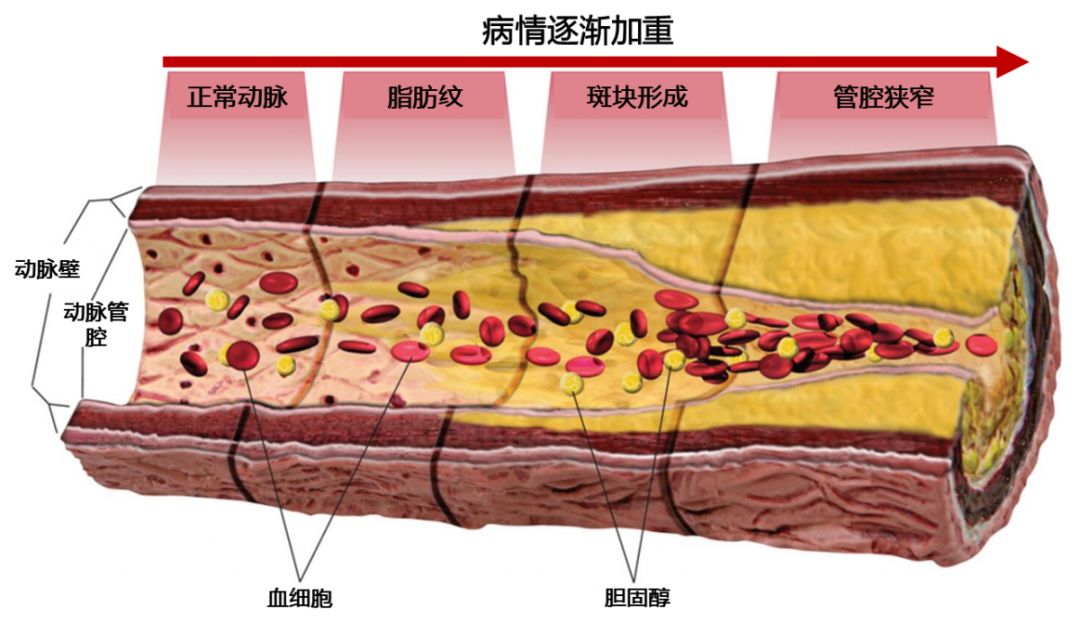 冠心病第一讲——冠心病是怎样发生的?