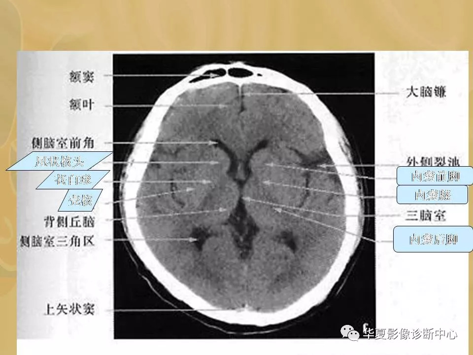 脑基底节区解剖图图片