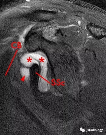 肩关节滑囊mri解剖图图片
