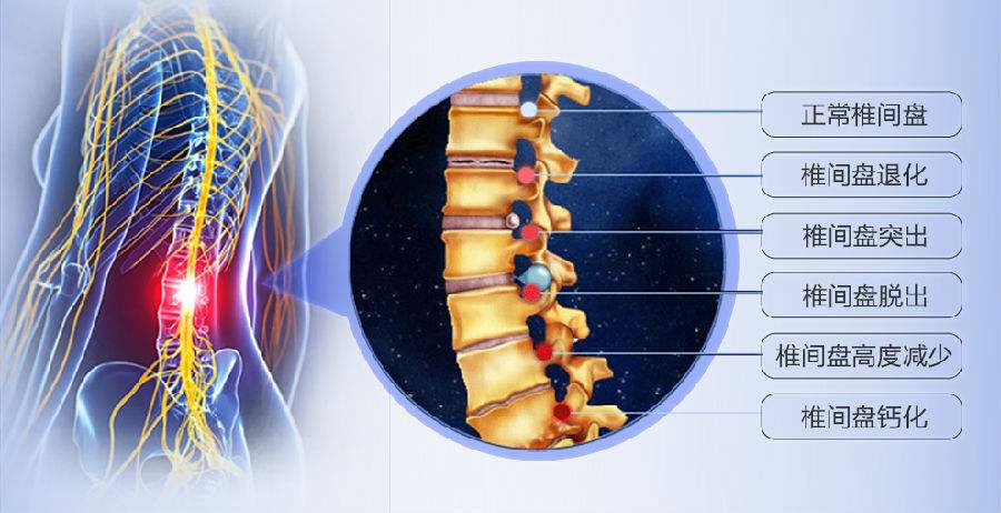 腰椎间盘突出不等于腰椎间盘突出症