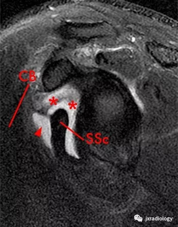 肩关节滑囊mri解剖图图片