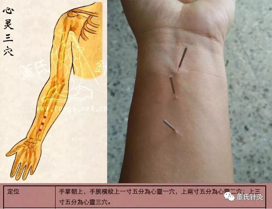 针灸腋缝透胛缝位置图图片