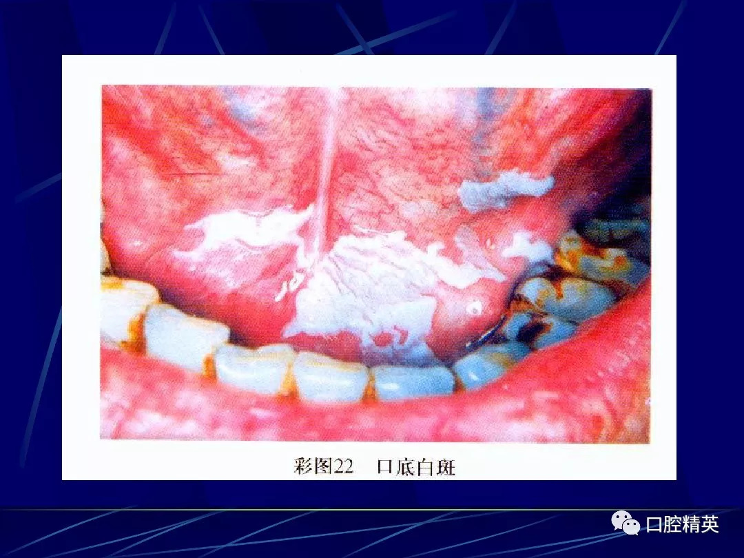 常見的口腔黏膜病