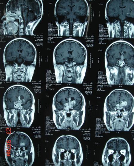 脑垂体瘤能活多久图片