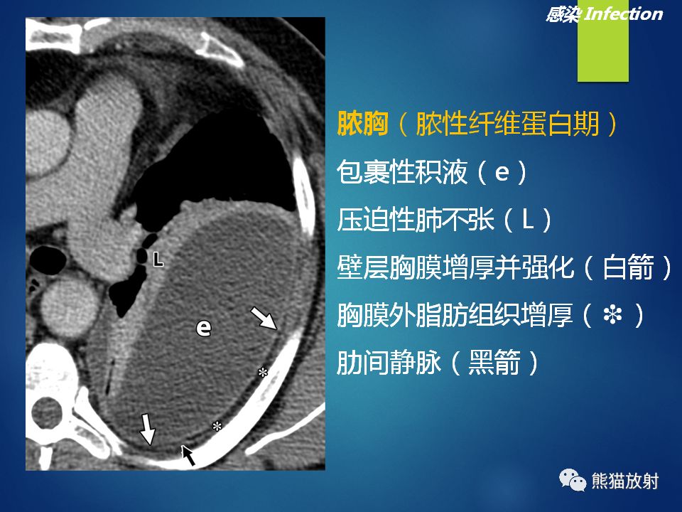 專題丨胸膜外間隙eps的ct評估