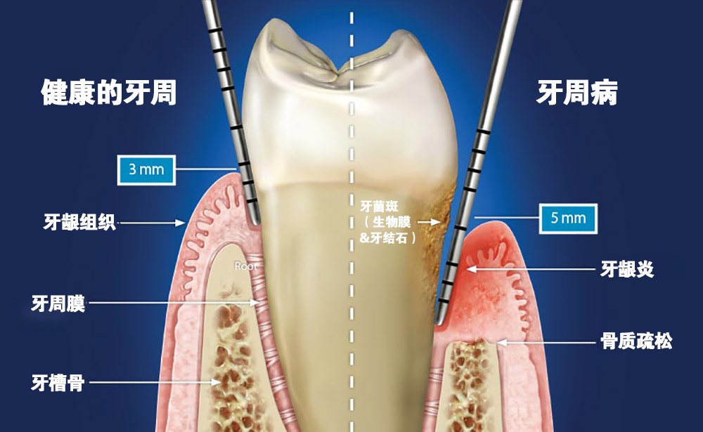 牙周的位置图片图片