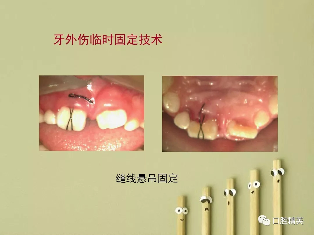 牙弓夹板固定术图解图片