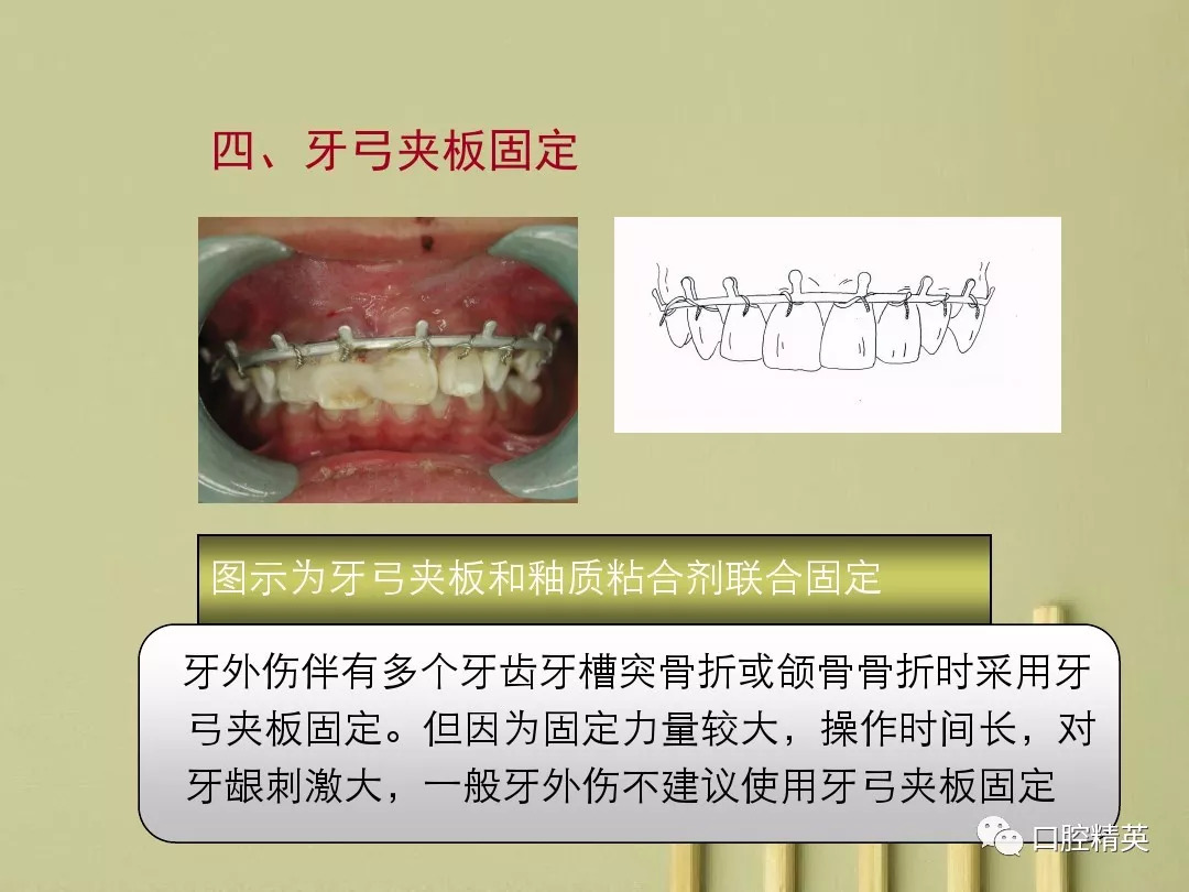 夹板固定牙齿示意图图片