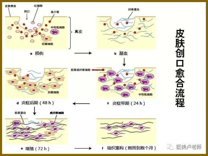 关注伤口修复中的表皮屏障功能_皮下组织