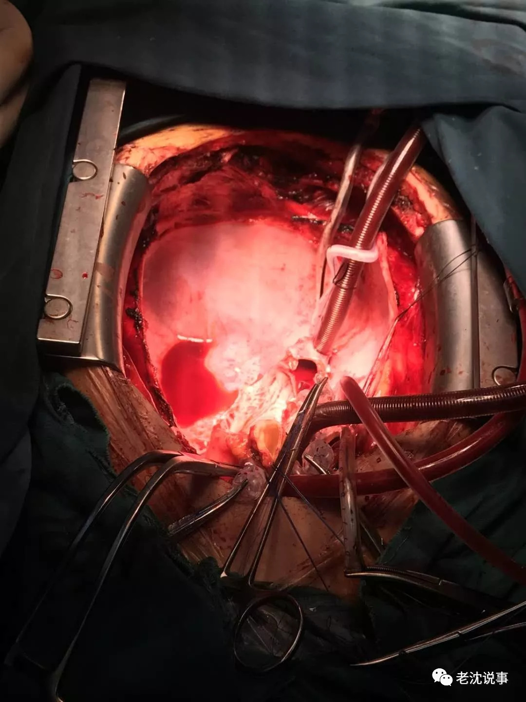 图文心脏移植的过程怎么移怎么植