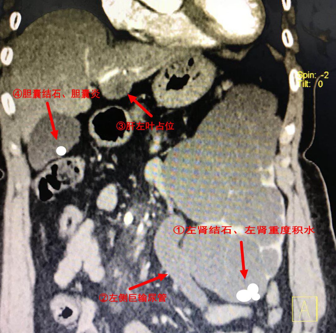 医生手记泌尿肝胆强强联手一次搞掂四个病变脏器
