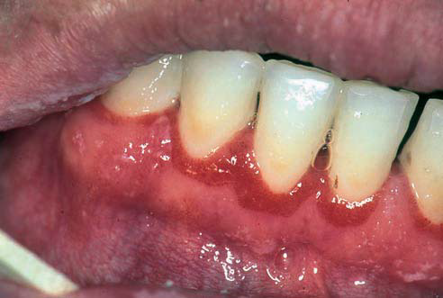 2,牙龈线形红斑