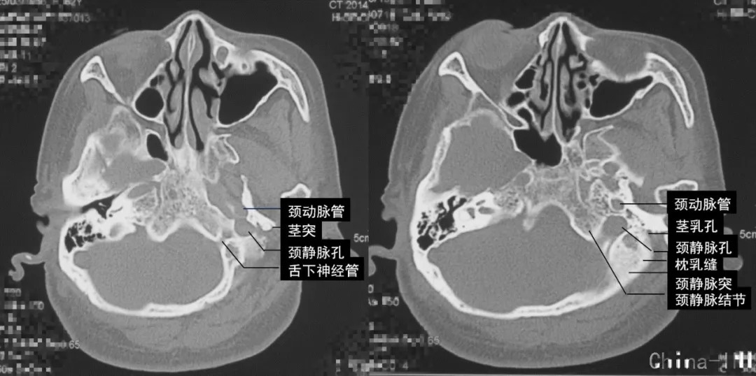 颈静脉孔ct解剖图图片