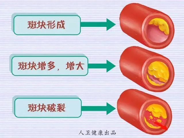 當血液中膽固醇增高時,容易形成動脈硬化斑塊,這些斑塊在動脈壁內堆積