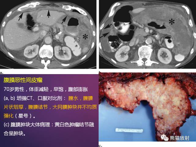 原发性腹膜肿瘤的影像表现