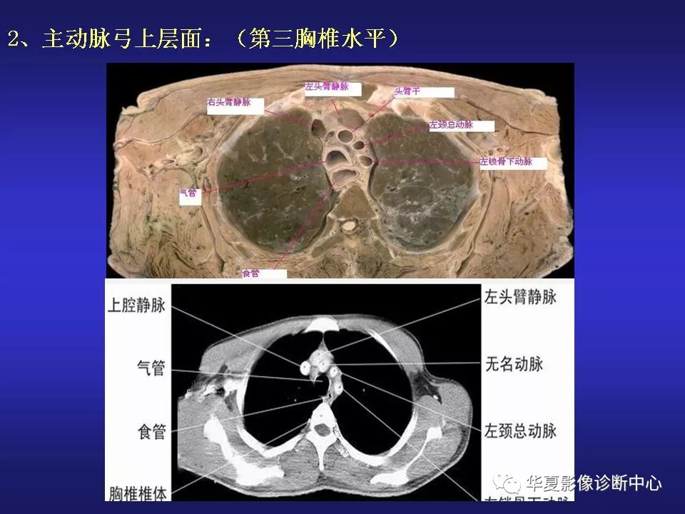 胸部ct解剖及常見病變診斷