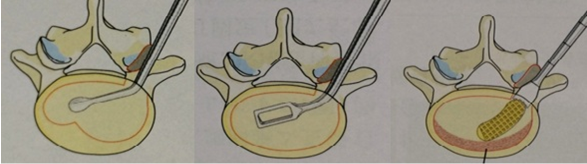 腰椎植骨融合内固定术图片