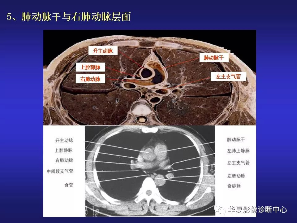 胸部ct解剖及常见病变诊断