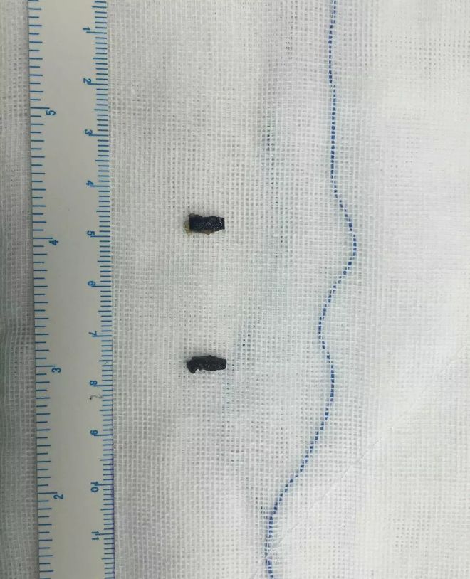 被取出的银夹银夹:逃了那么久还是逃不出医生的手术钳