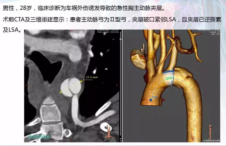 castor手术图片