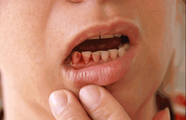 肝癌牙龈出血的图片图片