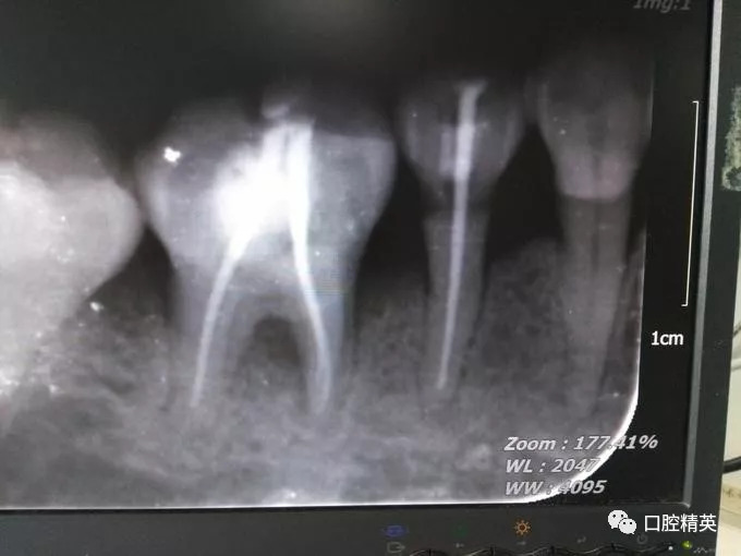 慢性牙髓炎1例