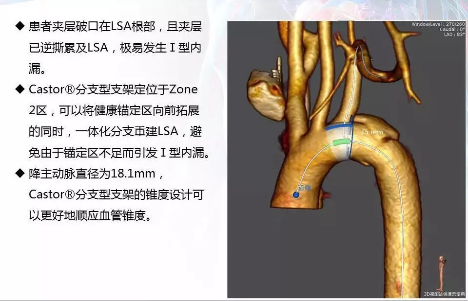 动脉覆膜支架系统治疗创伤性胸主动脉夹层 ——兰州大学第一医院