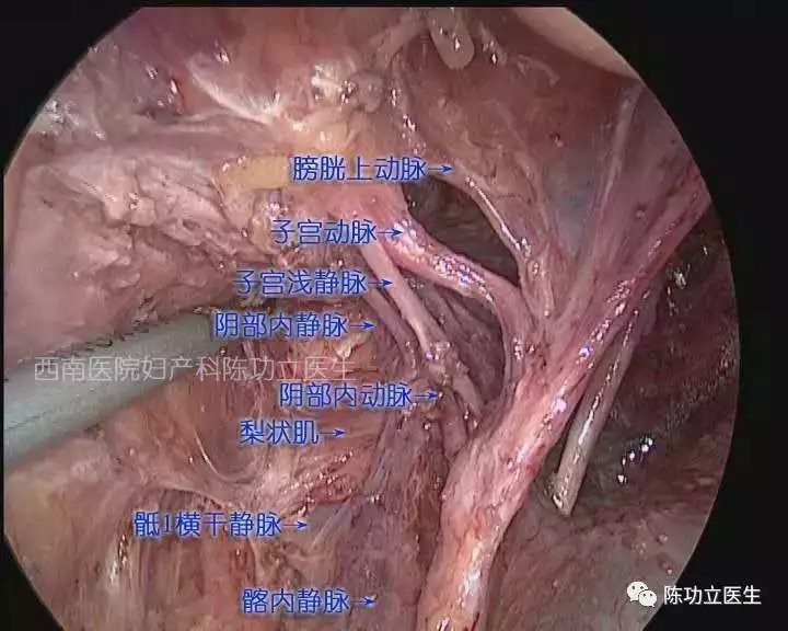 這幅圖可以看到膀胱上動脈,子宮淺靜脈和骶1橫幹靜脈.