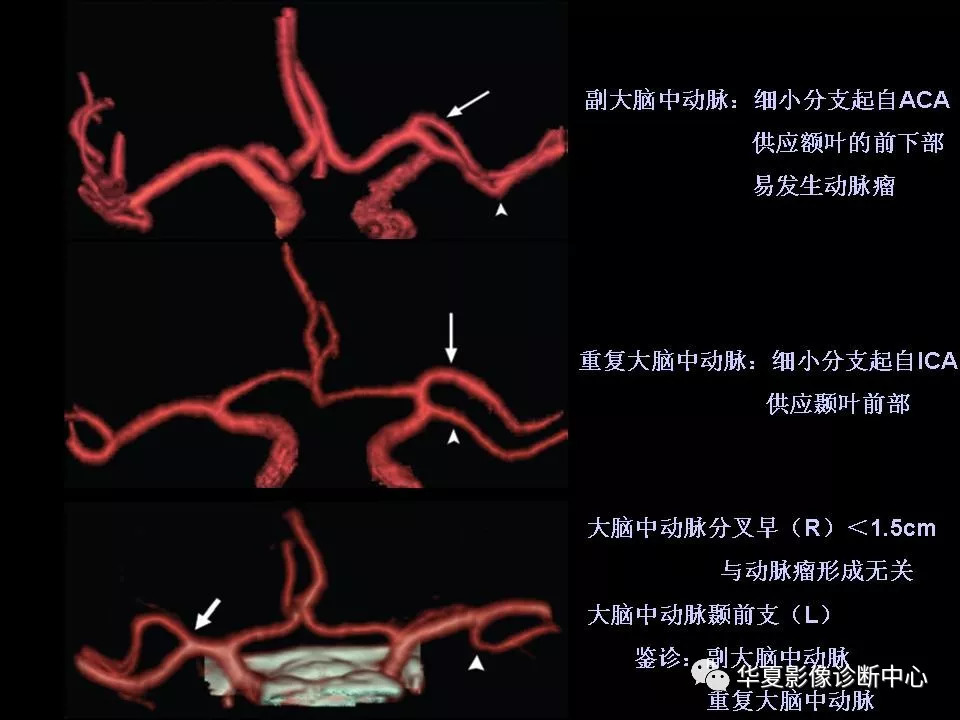 三倍体大脑前动脉图片