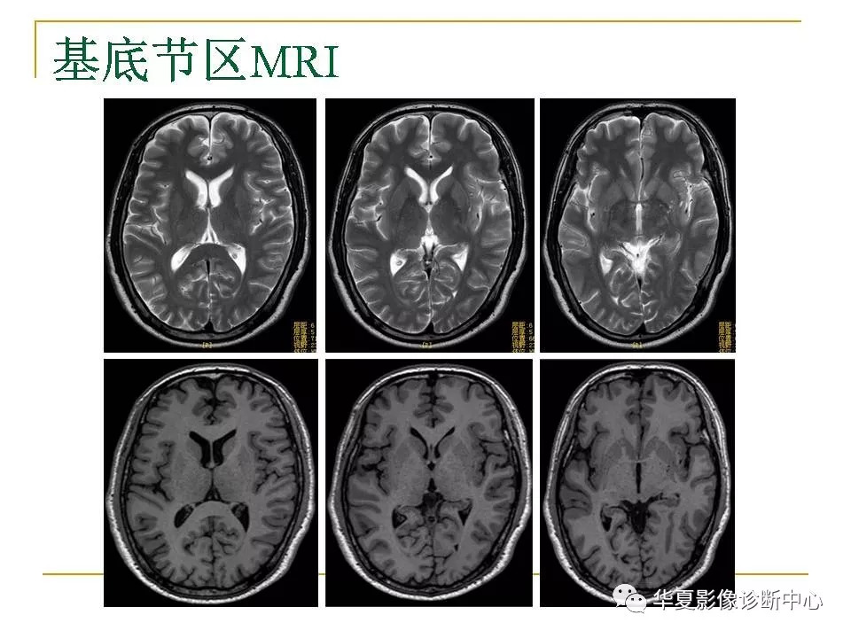 腦mri常用解剖