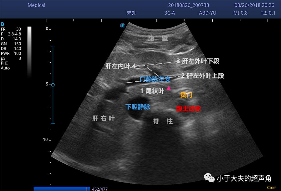 揭秘:静脉韧带 — 引导我们了解小网膜及网膜囊