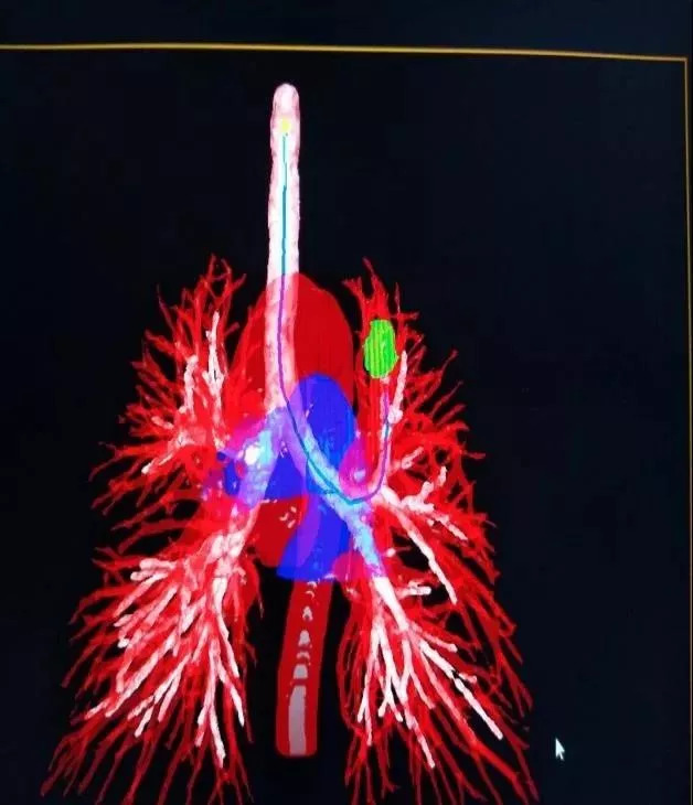 將ct數據導入lungpro全肺診療導航系統後,系統自動重建全肺血管氣管