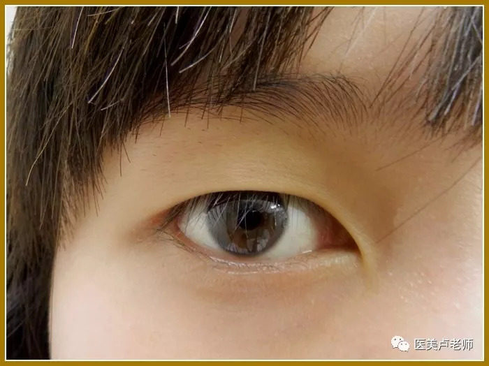 亚洲黄种人(蒙古人种或马来人种)的眼角从外层到内层是一个立体的眼角