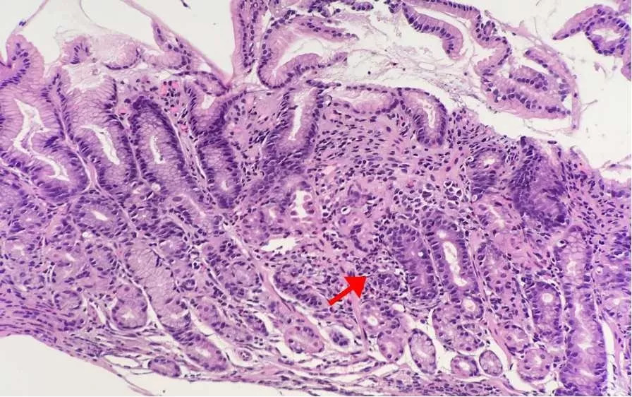 局灶增强性胃炎,在背景正常的胃黏膜组织中,出现局灶炎症细胞围绕单个