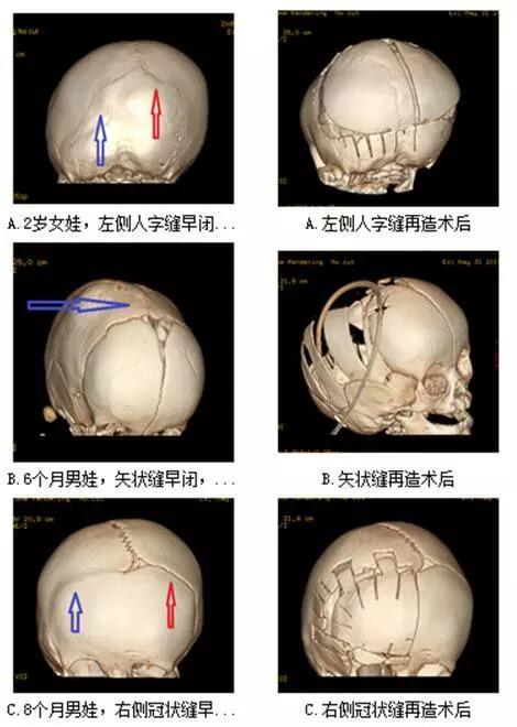 冠状缝矢状缝人字缝图片