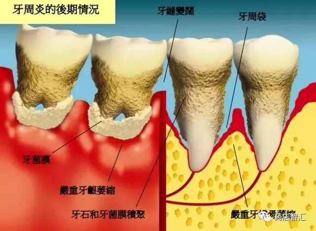 牙周炎与牙龈炎的4大区别点及联合用药方案