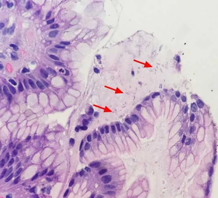 幽门螺杆菌胃炎,黏膜固有层表浅浆细胞呈带状密集浸润,伴活动性炎