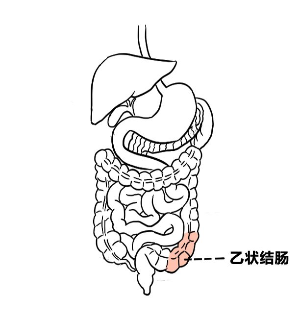 乙状结肠炎症图片