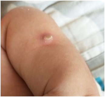 婴儿打卡介苗化脓图片图片