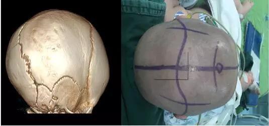 舟状头ct及术前颅缝早闭的影响宝宝出生后的头围增长,是靠大脑组织的
