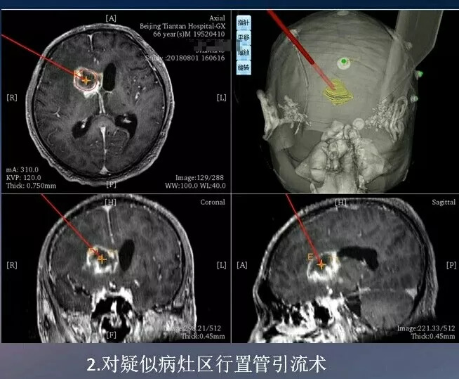 三,左側腦室腹腔分流患者頭側臥位,在機器人定位下,實施右側腦室穿刺