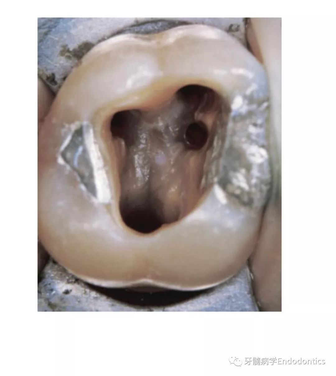 上颌6开髓口形状图片