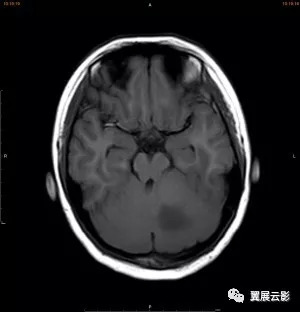 病例13岁男孩左侧小脑占位性病变