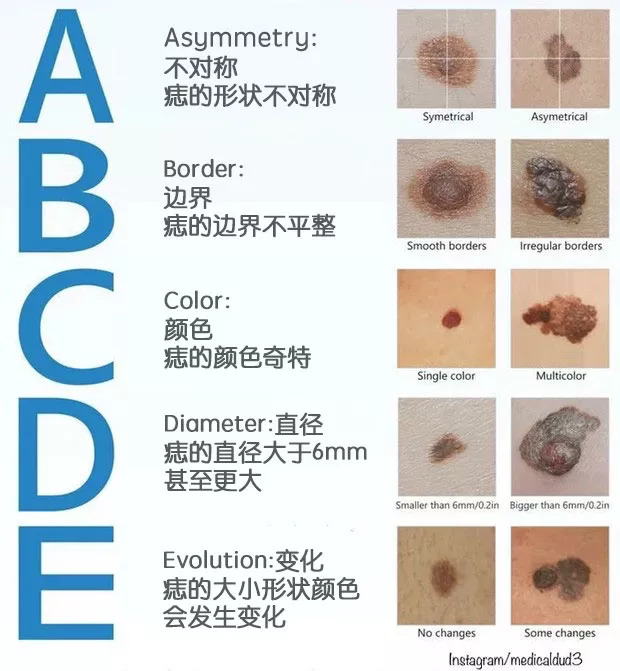 而25%的黑色素瘤都由痣變化而來.