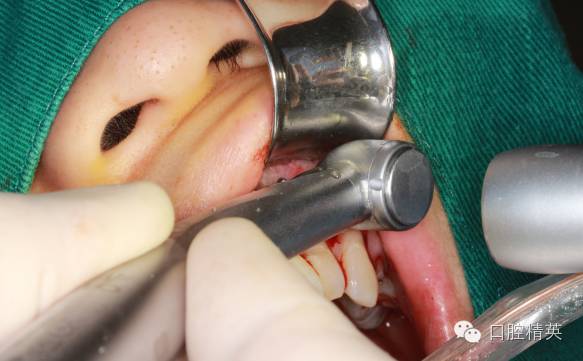 图解:左上侧切牙根尖切除术