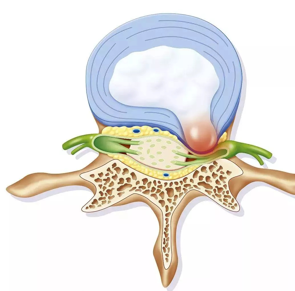 令人疼痛難忍的腰椎間盤突出究竟咋回事5位一體的保養動作快速學起來