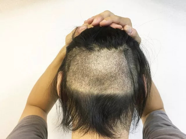 日本秃顶小哥做了项植发手术,整个过程看完后,直叫人头皮发麻!