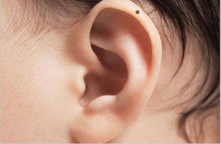 女人耳朵痣图片