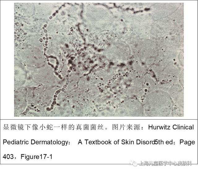 脚气真菌显微镜图片图片