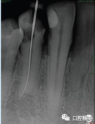下颌第一前磨牙根尖分歧根管治疗临床报道